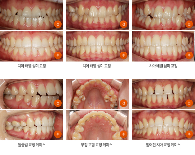 치아교정 전후사진1