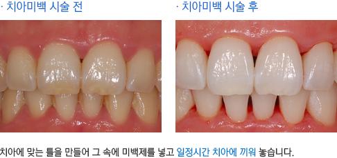 치아에 맞는 틀을 만들어 그 속에 미백제를 넣고 일정시간 치아에 끼워 놓습니다.